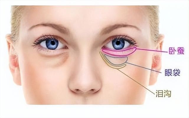 眼袋是怎样产生的如何消除 如何通过非手术方法消除眼袋