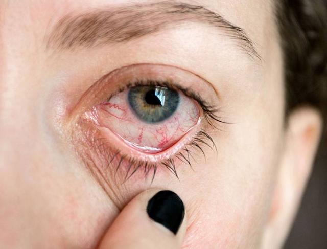 眼里红血丝的最佳改善方法有哪些 如何通过眼部护理来缓解眼里红血丝