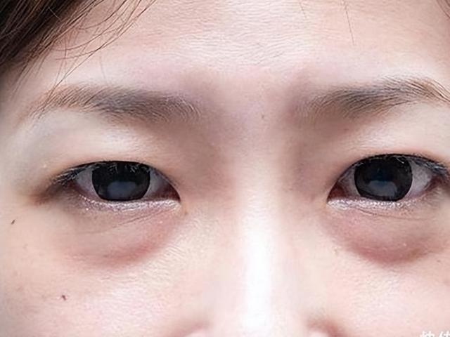 学生眼袋是怎样产生的如何消除 哪些专业的美容方法可以帮助消除学生眼袋