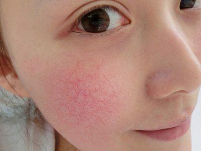 脸上红血丝如何治疗 如何预防脸上红血丝