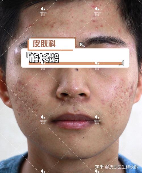 脸上痘坑能恢复到正常皮肤吗 如何预防痘坑的形成