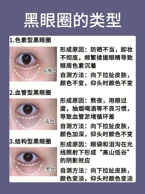 结构型黑眼圈怎么改善 如何改善结构型黑眼圈非手术方法