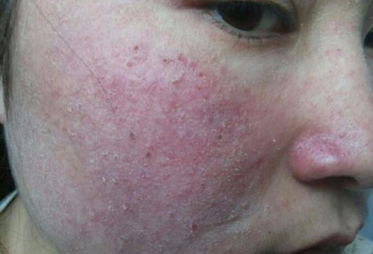 脸上激素脸有哪些症状 粉刺和红斑