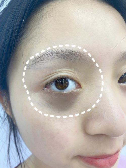 学生去黑眼圈最有效的方法 如何通过护肤品缓解和去除黑眼圈