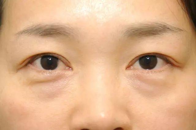 眼肿眼袋大是什么原因 如何减少眼肿眼袋大