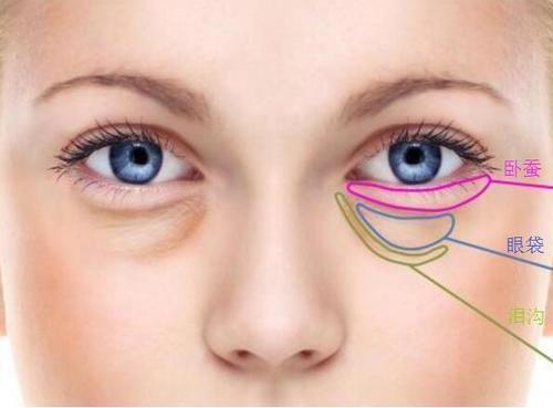 眼袋是怎样消除 如何通过非手术方法消除眼袋